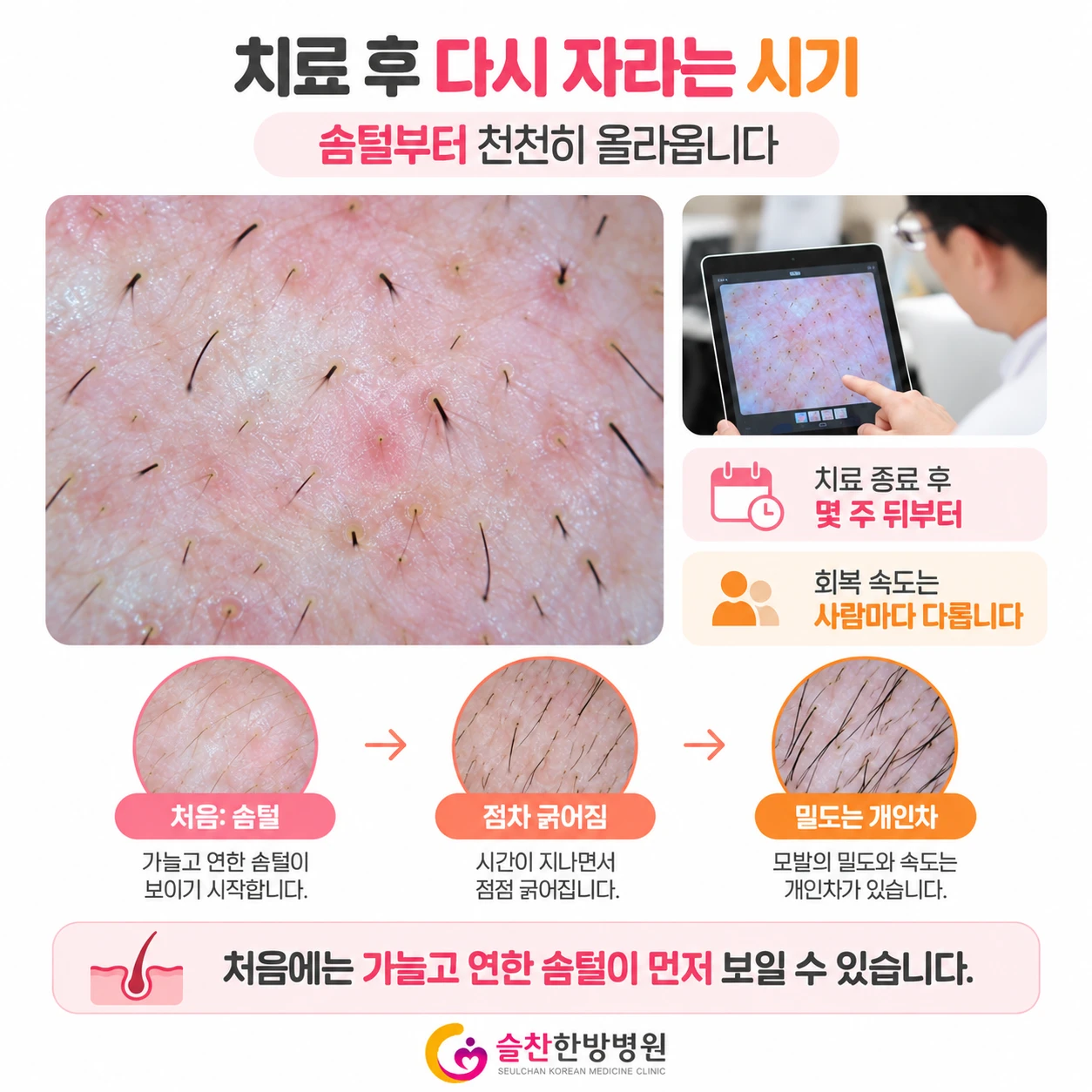 회복기 모발 변화 — 솜털에서 굵은 모발로